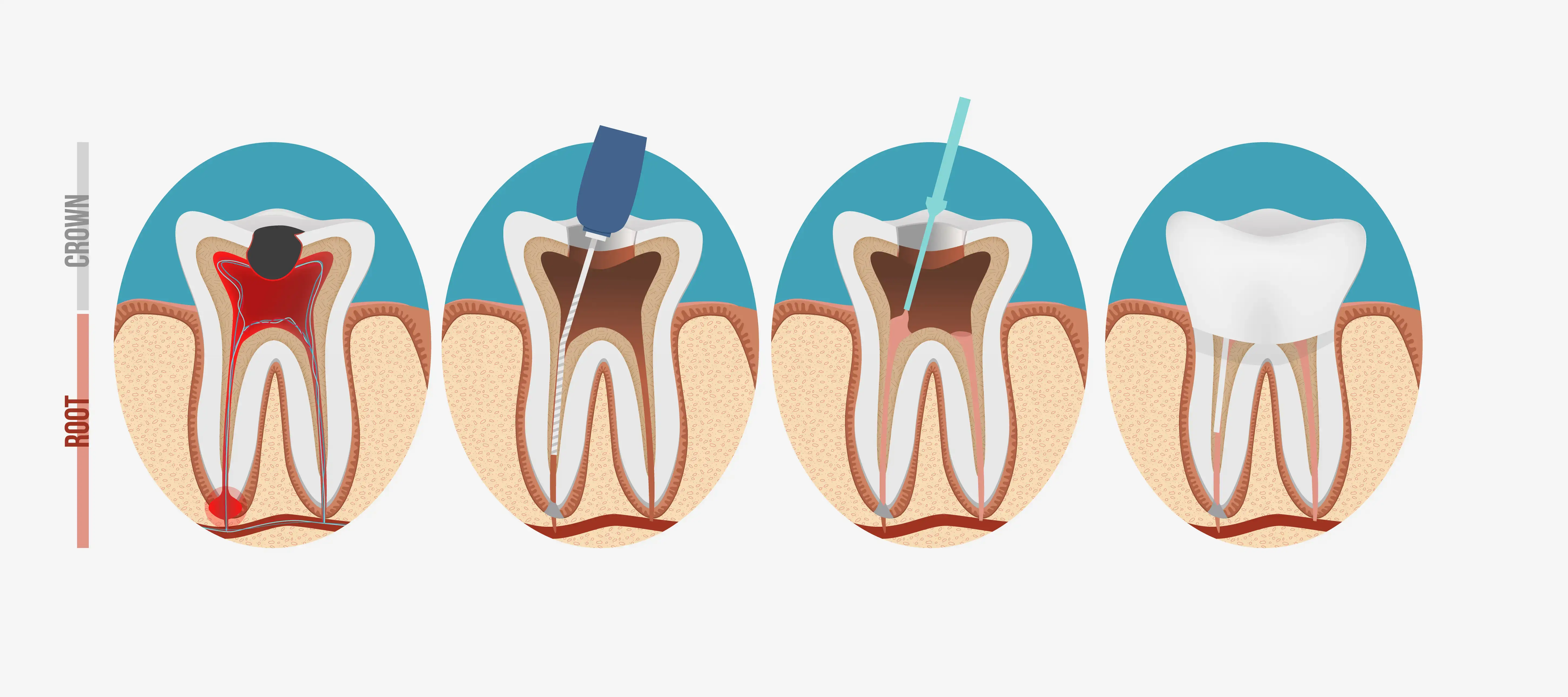 What is the difference between an Apicoectomy and a root canal.