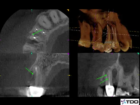 A digital X-ray with a small green arrow pointing out sensitive areas around the teeth.