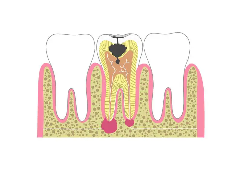 Management of Endodontic infections.