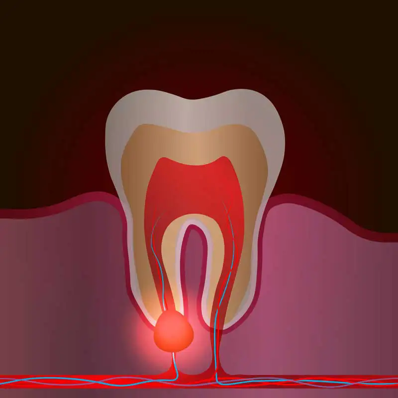 Management of Endodontic flare-ups-tooth pain.
