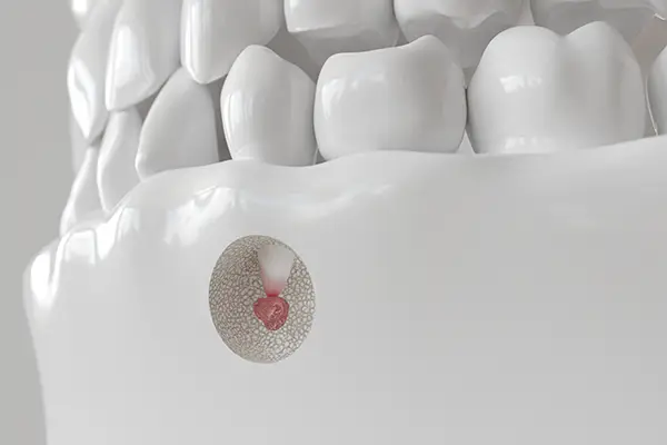 Extreme close up of the lower jaw and teeth, a piece cut away into the jaw bone revealing the infected root of a tooth that will need to restored during an apicoectomy procedure.