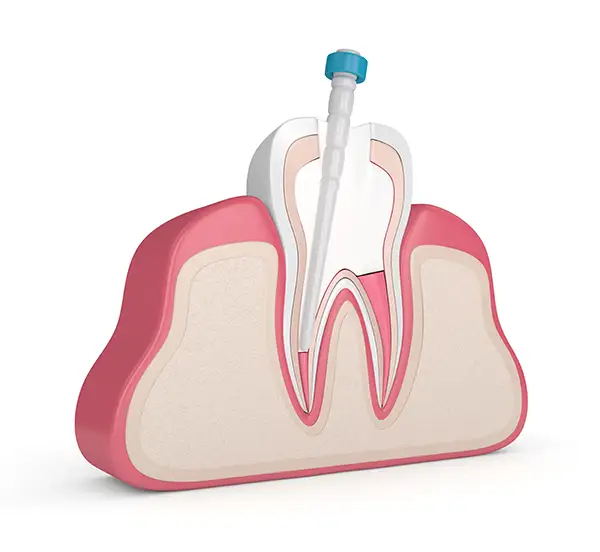 Cross-section of an unhealthy tooth undergoing root canal treatment with a tool inserted into the canal.