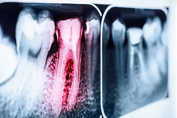 Dental X-ray highlighting an infected tooth root canal with inflammation in red.