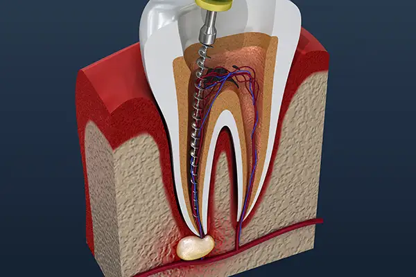 Detailed cross-section illustration of a root canal procedure showing the cleaning of infected tooth pulp.