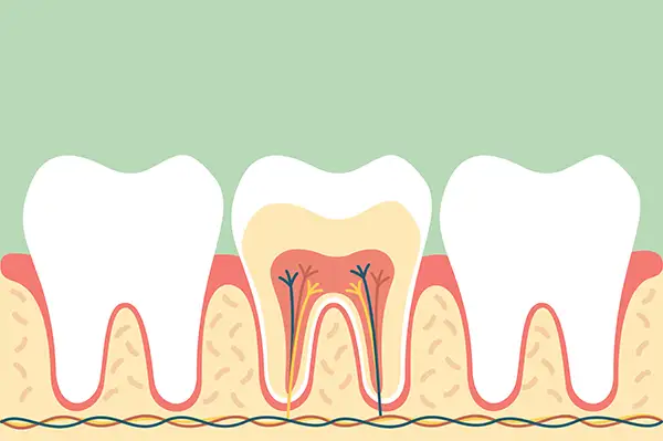 Cross-section of a tooth's root and nerve structure, emphasizing the importance of root canal treatment.